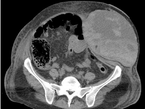 Imaging Of The Anterior Abdominal Wall A Radiological Review My XXX