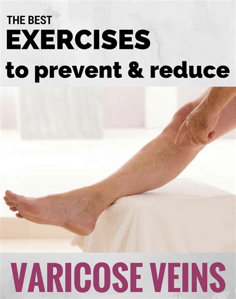 The Best Exercises For Varicose Veins Top Varicose Vein