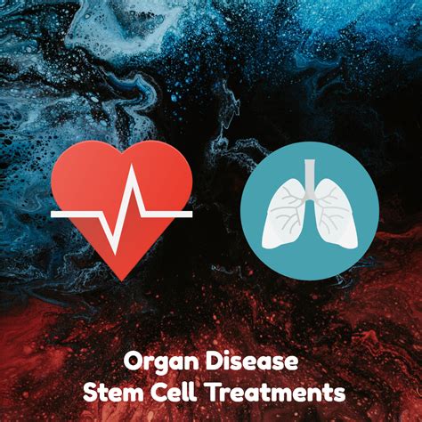 Organ Disease Stem Cell Treatment Prices And Info Dreambody Clinic