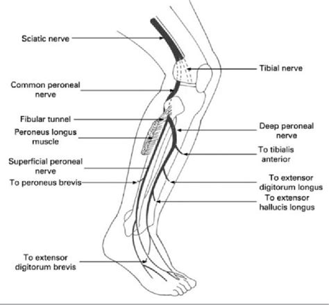 Common Peroneal Nerve Palsy Interactive Case Study Cl