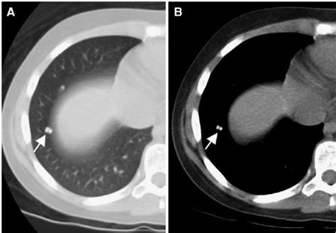 Example Of A Malignant Pulmonary Nodule Axial Ct Images In Lung A