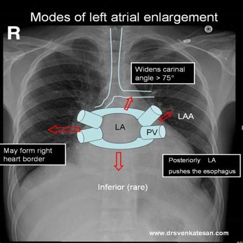 How Do You Identify Left Atrial Enlargement In X Ray Chest Drs