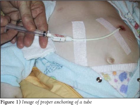 Figure 1 From A Guide To The Management Of Common Gastrostomy And