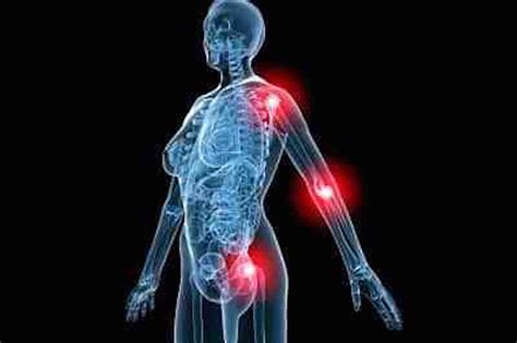 Bone And Joint Pain In Mpn Patients Explained Proliferative Pv Reporter