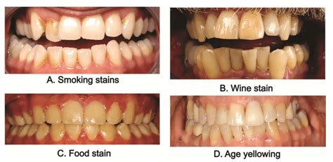remove coffee stains from behind teeth the science behind teeth whitening braddon dental