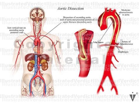 Stock Thorax Aortic Dissection — Illustrated Verdict