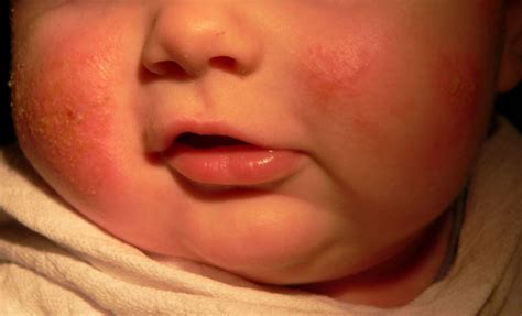 Early Onset Eczema May Increase Risk For Childhood Asthma Pulmonology