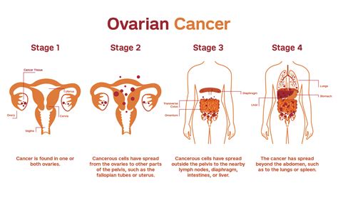 Cáncer De Ovario Causas Síntomas Y Tratamiento