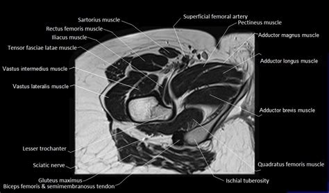 for detailed anatomy of pelvic bones, read anatomy of hip bone. MRI anatomy of hip joint | free MRI axial hip anatomy