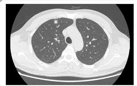 Upper Lobe Lung Nodule