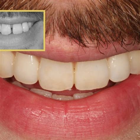 Teeth Straightening Treatment London Dr Gurs Sehmi Cosmetic Dentist