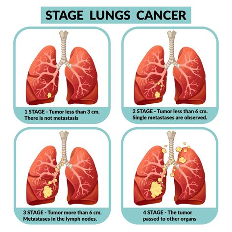 Tipos De Cancer No Pulmão