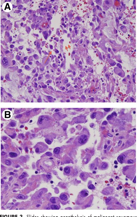 Figure 3 From Acantholytic Squamous Cell Carcinoma Of The Buccal Mucosa