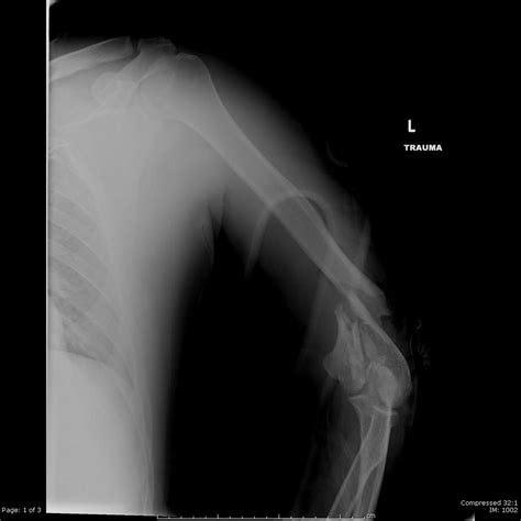 Distal Humerus Fractures Trauma Orthobullets