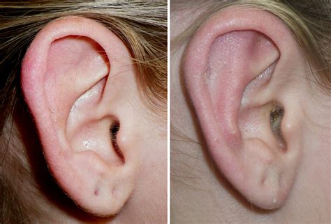 Protruding Ears Gallery Richmond Va Cosmetic Facial Surgery