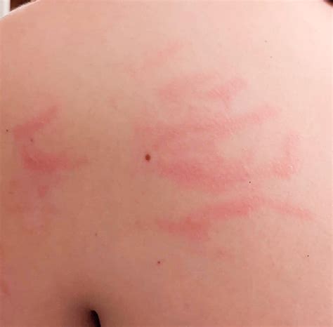 Dumbfounded By Weird Recurring Rash Info In Comments