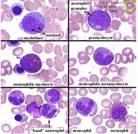 Promyelocyte Vs Myelocyte In The Neurtrophilic Pictures Hematología