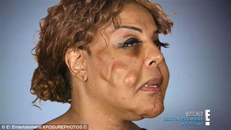 Transgender Woman Who Had Cement And Tire Sealant Injected Into Her