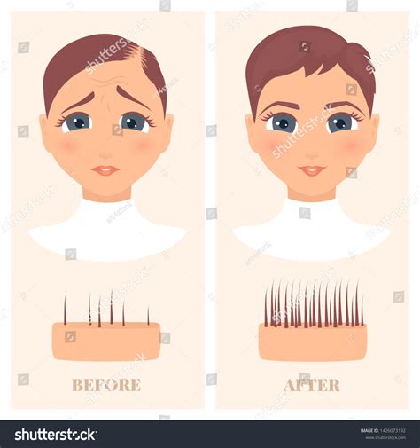 Woman Thinning Hair Before After Hair Stock Vector Royalty Free