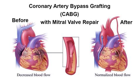Coronary Artery Bypass Graft Treatment In India