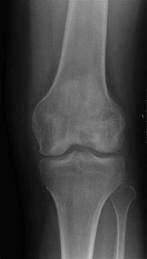 Ap X Ray View Of The Left Knee Showing Sclerosis And Increased Lucency