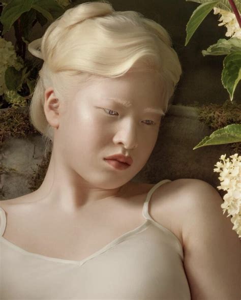 Albino Girl Gets Abandoned As A Baby Grows Up To Become A Vogue Model