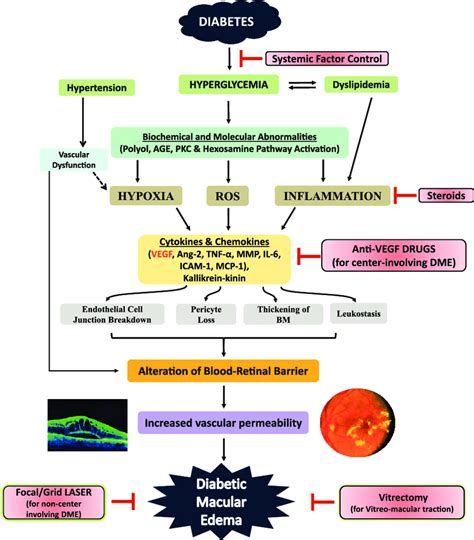 Pathophysiology Of Diabetic Macular Edema Dme And Different