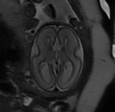 Agenesis Of The Corpus Callosum Radiology Case Radiopaedia Org