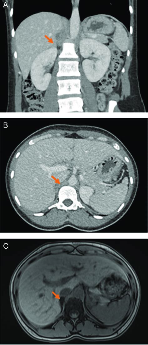 Imaging Of The Adrenal Glands Non Contrast Ct Adrenal Of The Patient