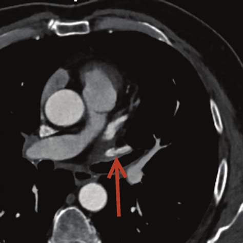 Left Pulmonary Vein Stenosis Computed Tomography Pulmonary Angiography