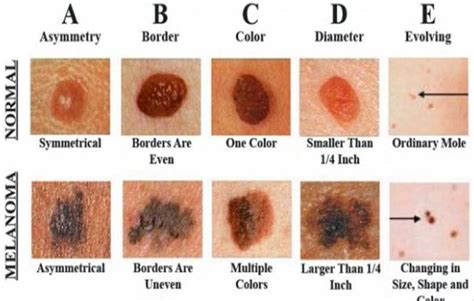 What Does Stage 1 Skin Cancer Look Like Cancerwalls