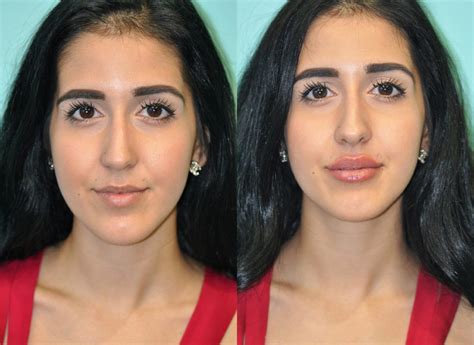 Lip Augmentation Photos Chevy Chase Md Patient 11858