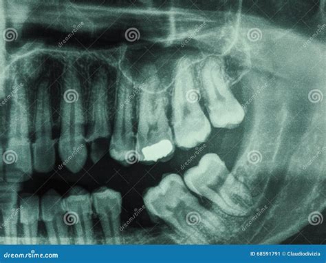 Human Teeth Xray Stock Image Image Of Xray Cure Dental 68591791
