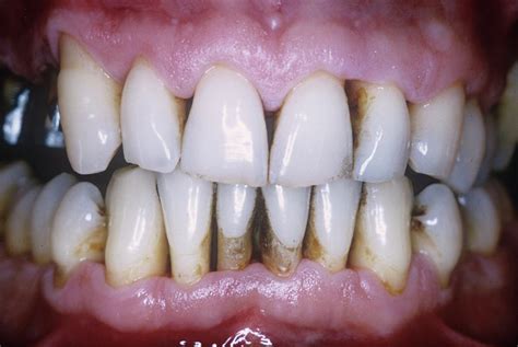Receding Gums In Gum Disease Photograph By Dr W Greencnriscience