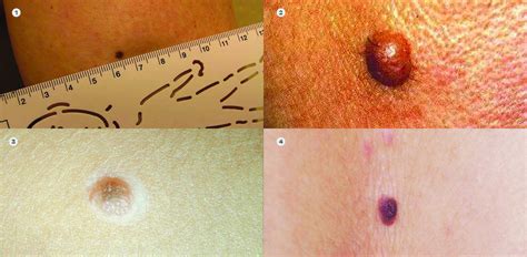 Detect Skin Cancer Body Mole Map Welcome To The Skin Mole Clinic