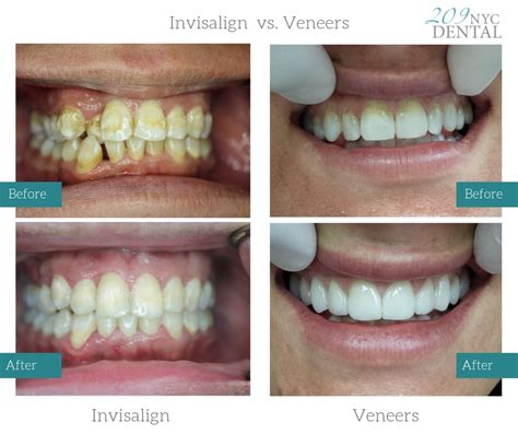Invisalign Vs Veneers All You Need To Know 2023