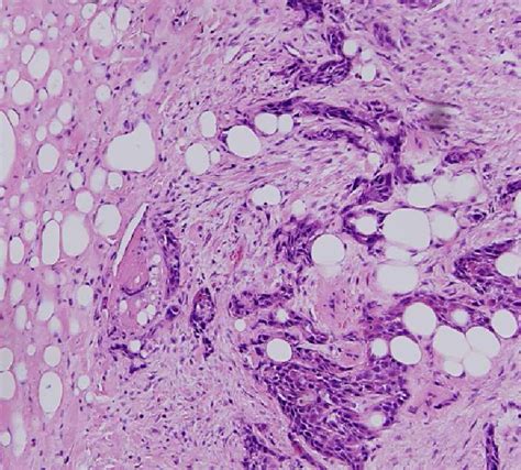 Histopathology Shows Metastatic Squamous Cell Carcinoma Infiltrating