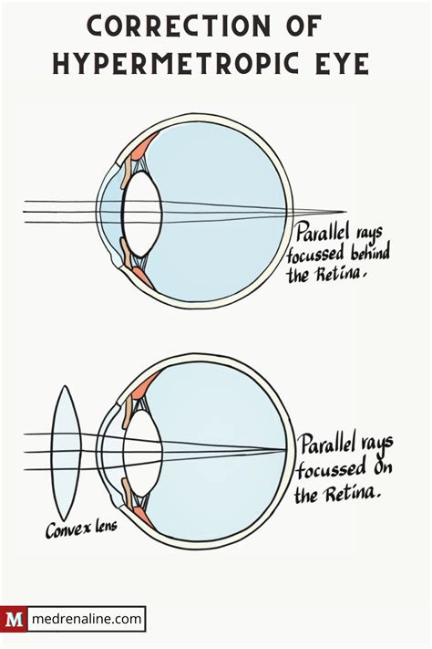 Correction Of Hypermetropic Eye Using A Convex Lens Lens The Retina