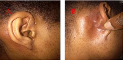 A preauricular sinus is a common congenital malformation characterized by a nodule, dent or dimple located anywhere adjacent to the external ear. Unusual Presentation of Preauricular Sinus Abscess—Case Report