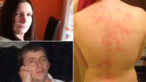 Woman Allergic To Her Own Husband Due To Ultra Rare Condition That Stops Her Kissing Him