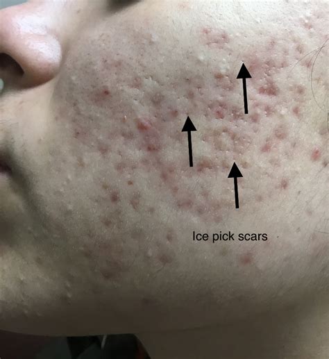 Treating Permanent Acne Scars Advanced Acne Institute