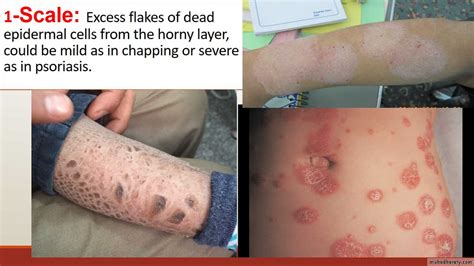 Diagnosis Of Skin Diseases Pptx D Hadf Muhadharaty Images And Photos