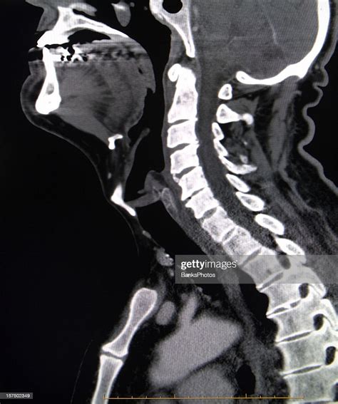 Cervical Spine Ct Scan High Res Stock Photo Getty Images