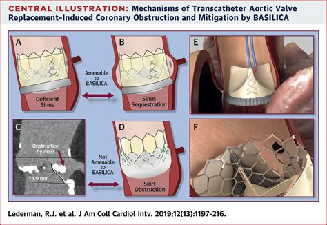 Preventing Coronary Obstruction During Transcatheter Aortic Valve