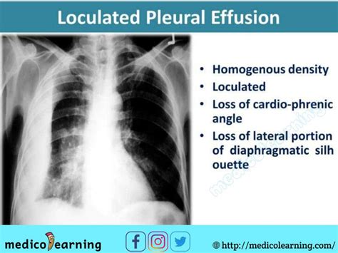 Local Pleural Effusion Medical Radiography Radiology Imaging