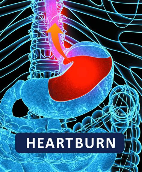 Does Heartburn Feel Like A Heart Attack Harvard Health