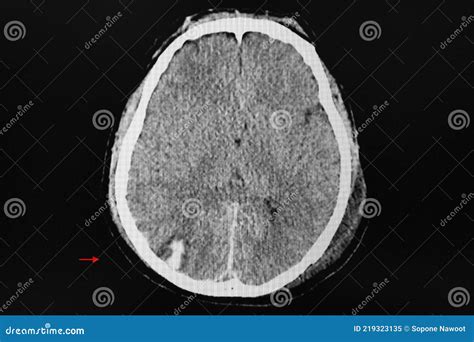 Ct Brain Showing Hemorrhagic Contusion At Right Occipital Lobe Stock