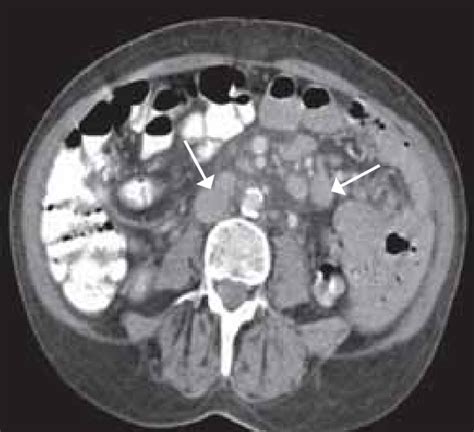 Axial Abdominal Ct Image Showing Enlarged Lymph Nodes In A Patient With