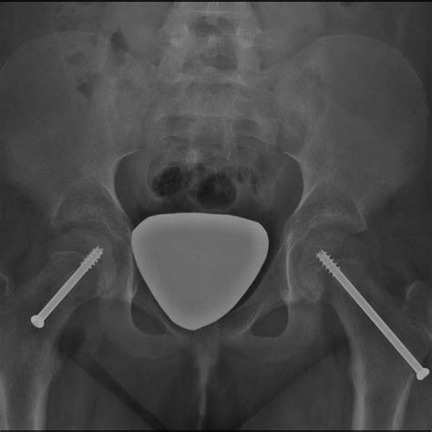 Anteroposterior Ap Pelvis Radiograph Showing Bilateral Percutaneous