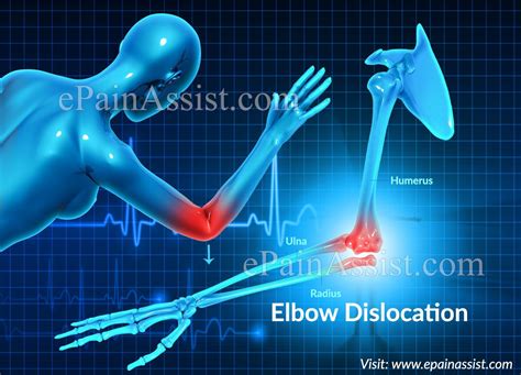 Elbow Dislocation Or Dislocated Elbow Dislocation Shoulder